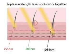  Laser-Enthaarung für 6 Fitzpatrick Hauttypen, FG2000-B 